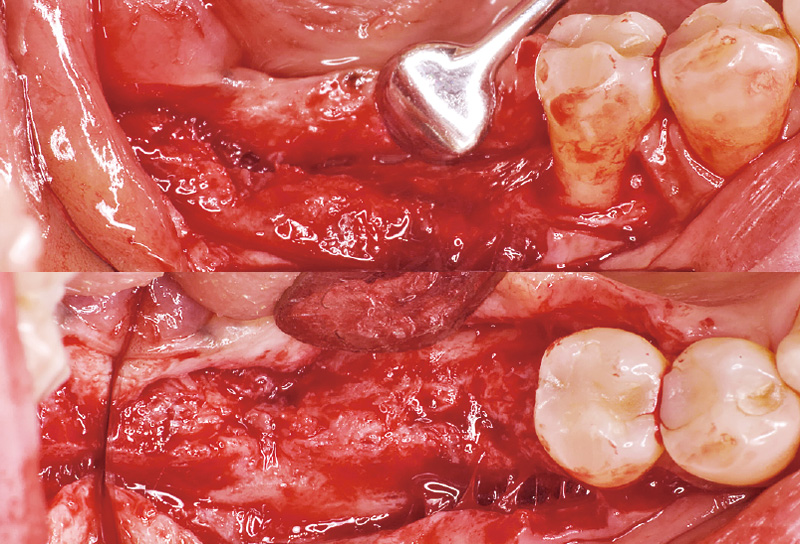[写真] 歯槽骨は水平、垂直的に吸収している