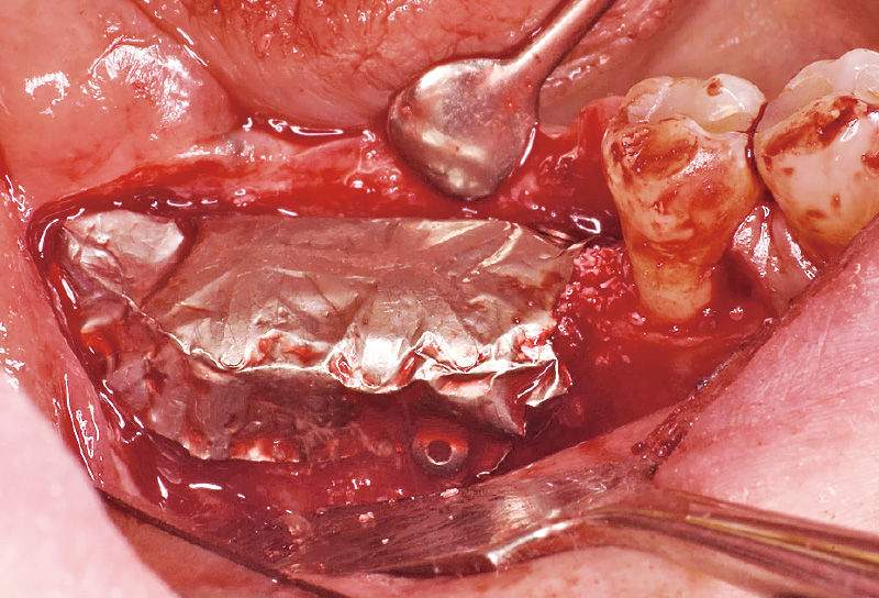 [写真] 埋入予定のインプラントショルダー部から頰舌的に2mmの位置を基準にフレームをベンディングした