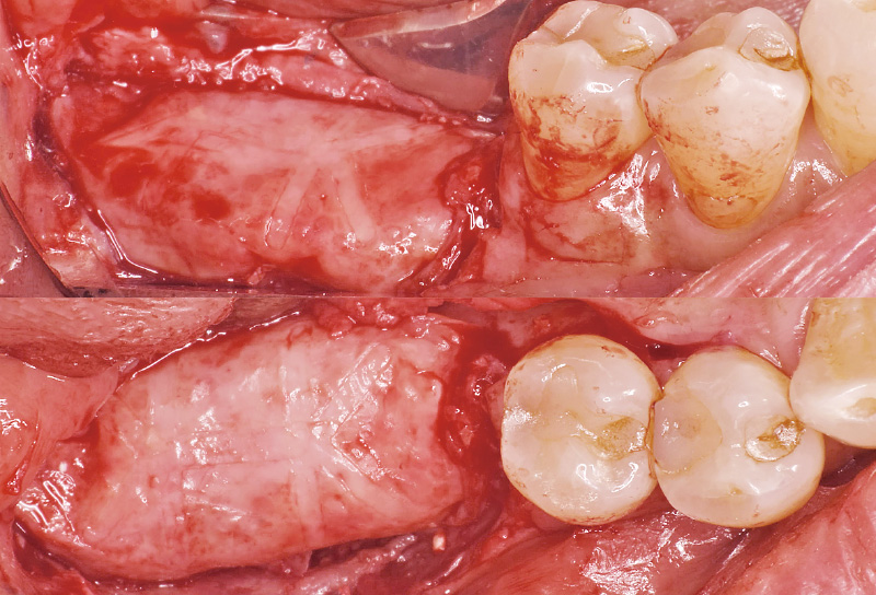 [写真] GBR後7ヵ月メンブレン下に薄い軟組織が存在した