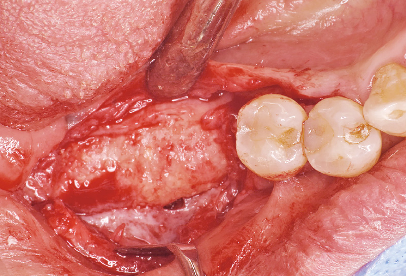 [写真] メンブレン下の軟組織を慎重に剥離すると硬く成熟した骨様組織を認めた
