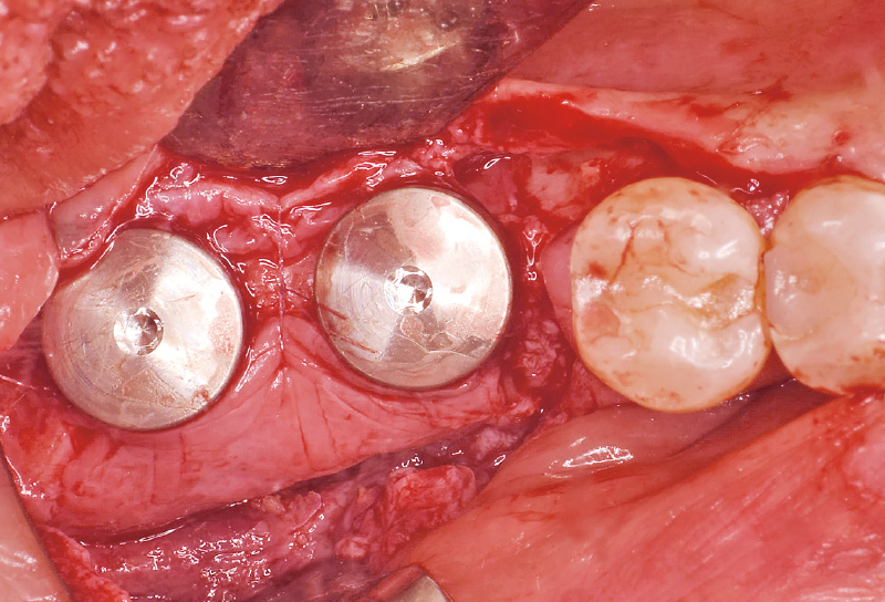 [写真] インプラントをやや深めに埋入し、吸収性縫合糸でメンブレン下に存在した軟組織を縫合し、角化粘膜根尖側に位置付けた