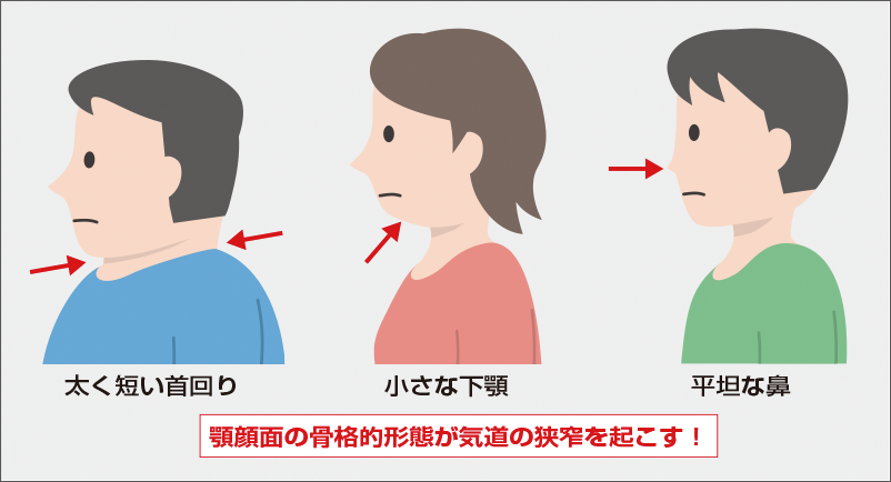 [図] OSA患者に多く見られる外見的特徴