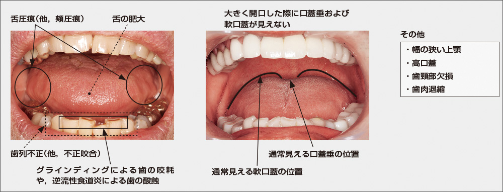 [図] OSA患者に多く見られる口腔内の症状