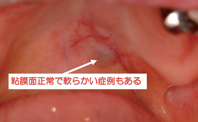 [写真] 小唾液腺腫瘍