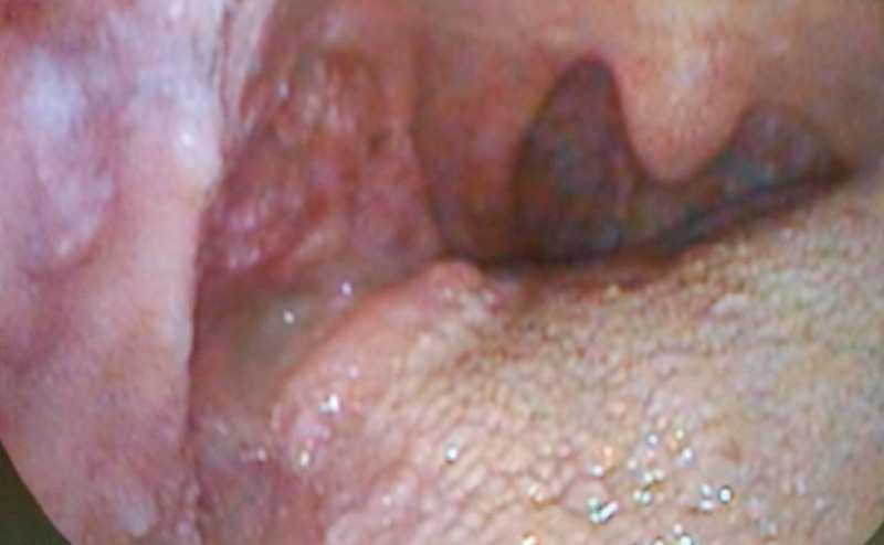 [写真] 高度難聴の患者さんの舌がん再発例