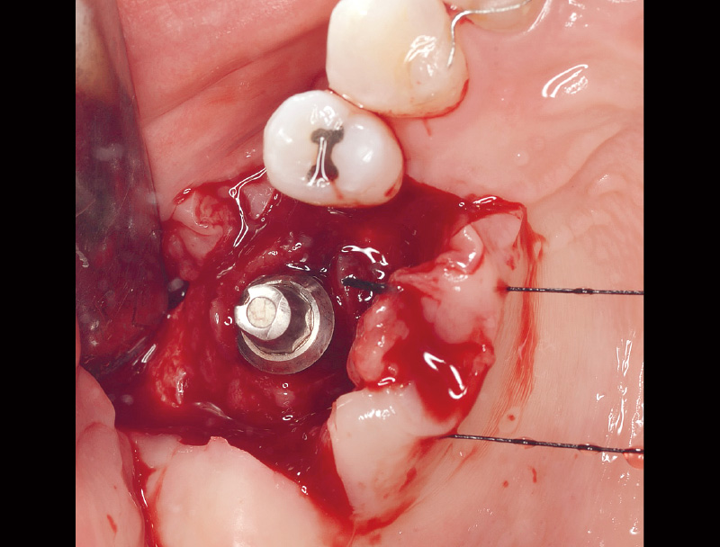 [写真] フラップを開くとインプラント体周囲は炎症性肉芽組織で覆われていた