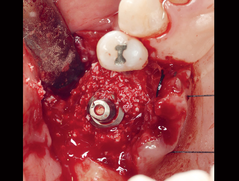 [写真] 骨欠損部に骨移植材を填入
