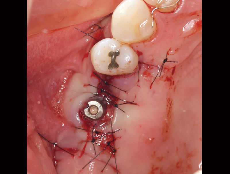 [写真] 粘膜弁をナイロン糸でアバットメントにしっかりと縫合