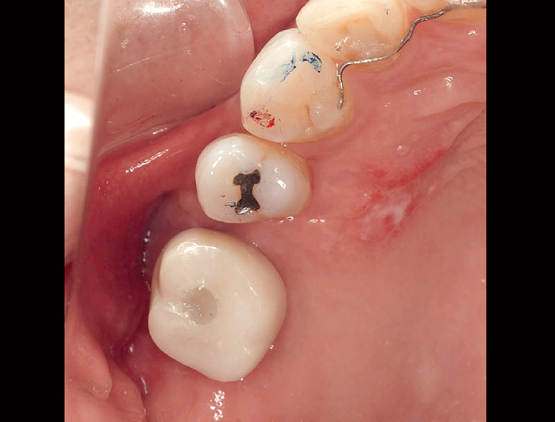 [写真] 清掃性を考慮し故意に5とのコンタクトを開けることとした