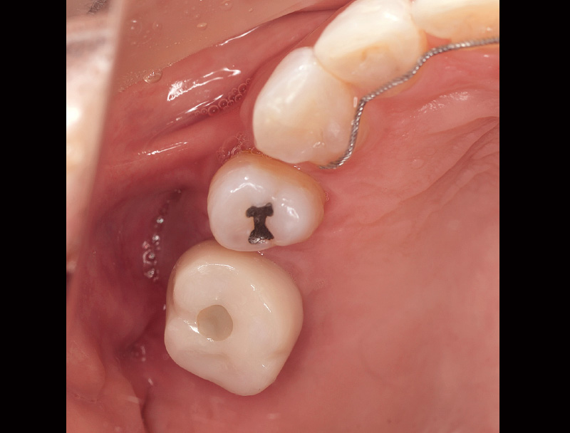 [写真] 3年後の口腔内写真