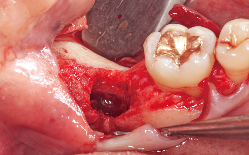 [写真] 抜歯後6ヵ月が経過するも骨は治癒しておらず、舌側の欠損が大きい