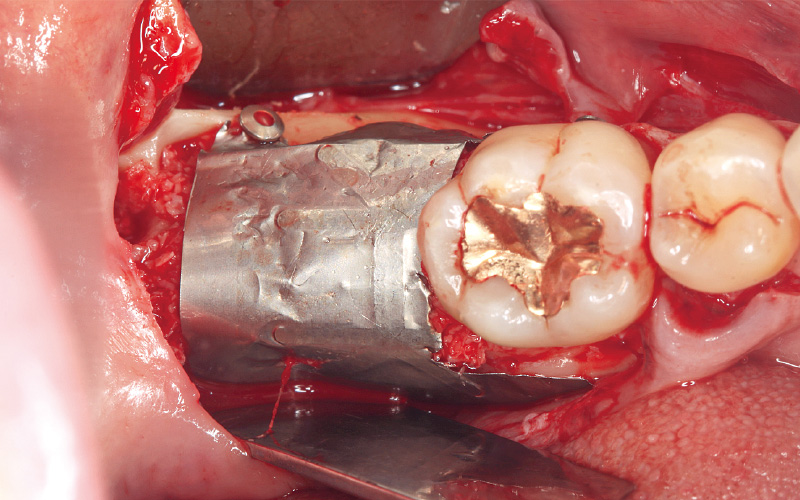 [写真] 骨移植材を填入し、Tiハニカムメンブレンで被覆した