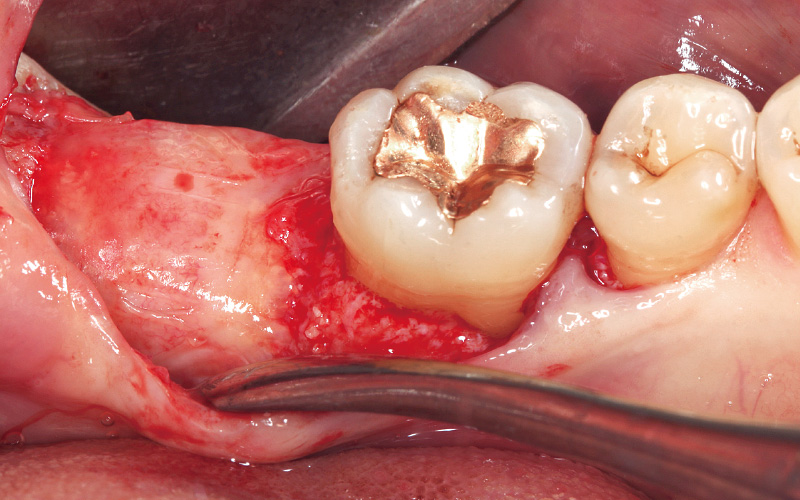 [写真] インプラントを埋入するための十分な骨の幅と高さが得られた