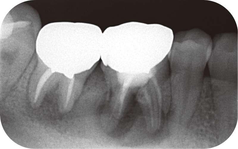 [写真] 6、7ともに根分岐部病変および根尖病変を認めた