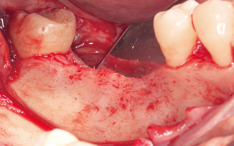 [写真] 水平的および垂直的な骨吸収を伴っていた（抜歯後5ヵ月）