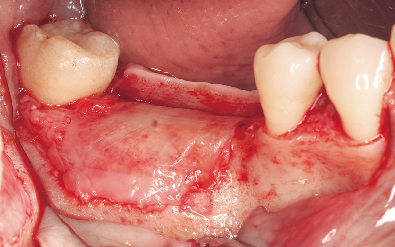 [写真] 補綴学的な部分を考慮した骨造成が達成されている