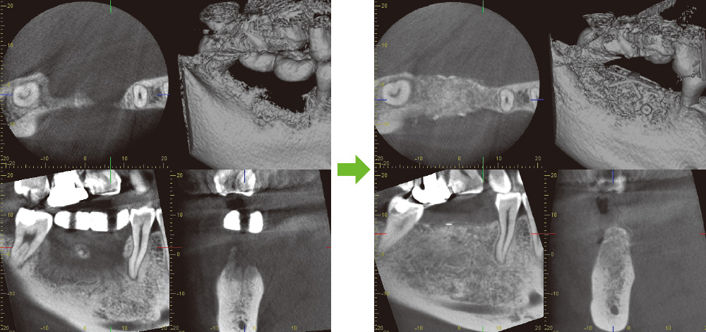 [写真] 6部の術前・術後のCBCT（株式会社モリタ製作所 Veraviewepocs X700にて撮影）