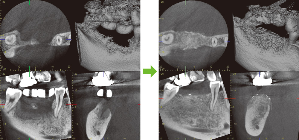 [写真] 7部の術前・術後のCBCT