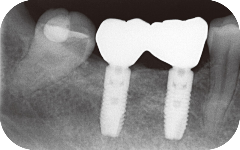 [写真] インプラント周囲の骨は安定している（GBR後4年）