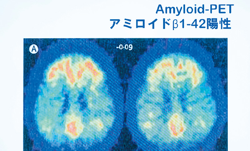[写真] 「アミロイドPET」診査