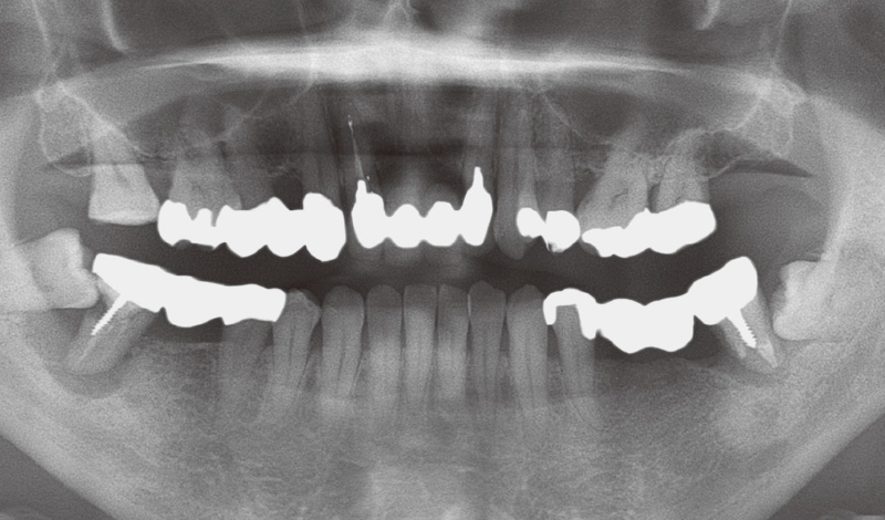 [写真] 初診時のパノラマX線写真