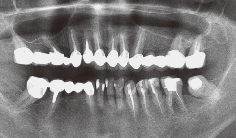 [写真] 初診時のパノラマX線写真