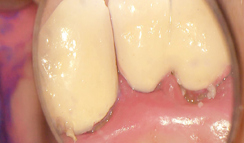 [写真] SRP前の発赤している歯肉の所見