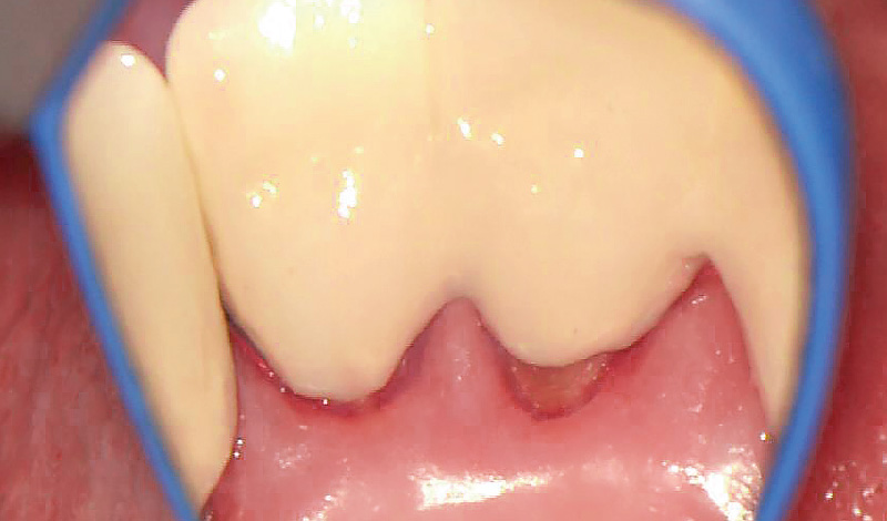 [写真] SRP後、症例2-4と同部位の発赤の改善が見られる歯肉の所見