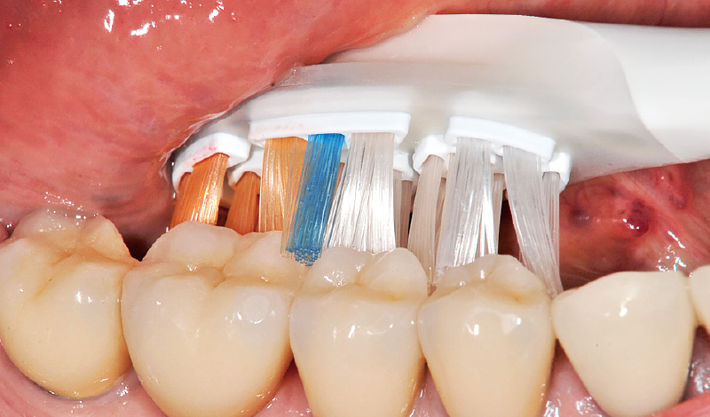 [写真] 歯と歯ぐきの境目までしっかり磨ける