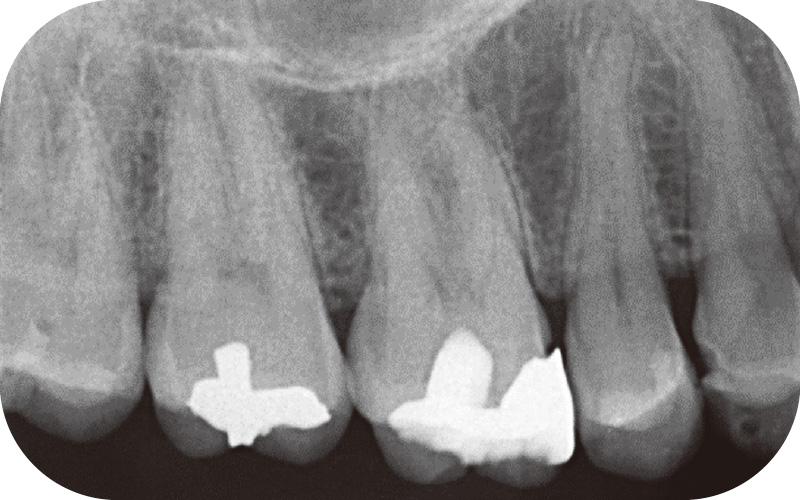 [写真] X線写真において、4遠心に透過像を認める