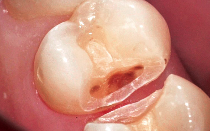 [写真] 古い充填物を除去した後の状態。遠心にう蝕を認める。