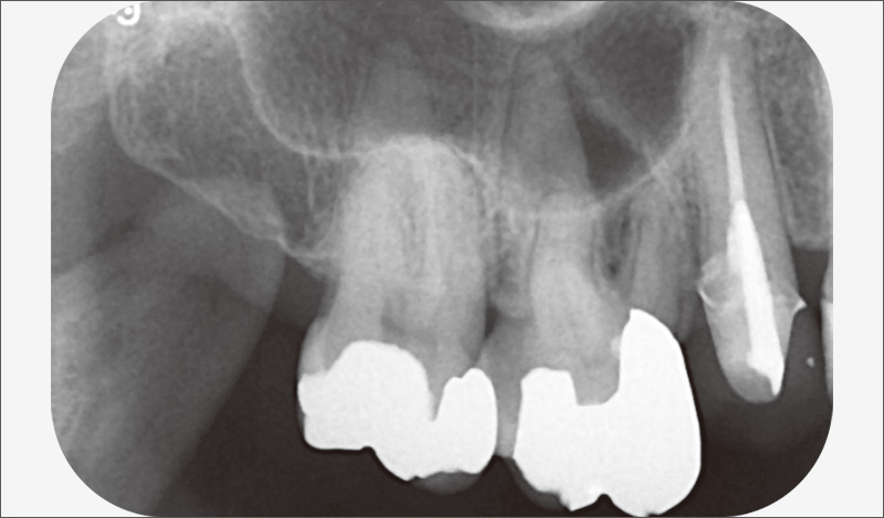 [写真] 術前のデンタルX線写真