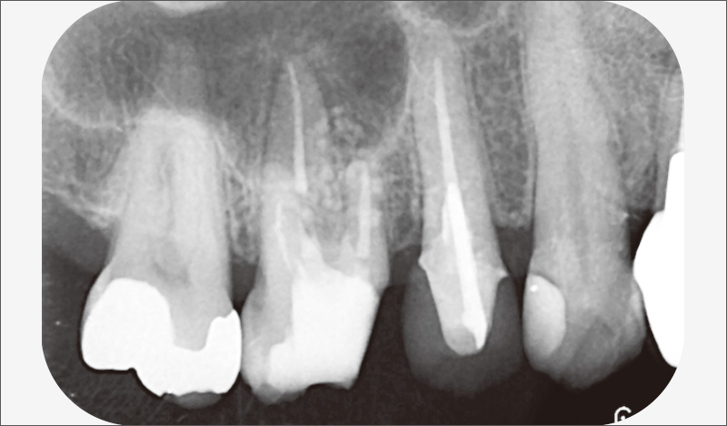 [写真] 術直後デンタルX線写真