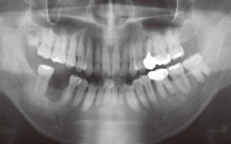 [写真] 術前のパノラマX線画像