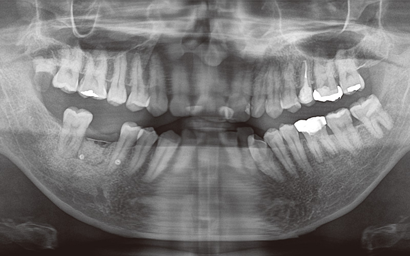 [写真] 術後のパノラマX線画像