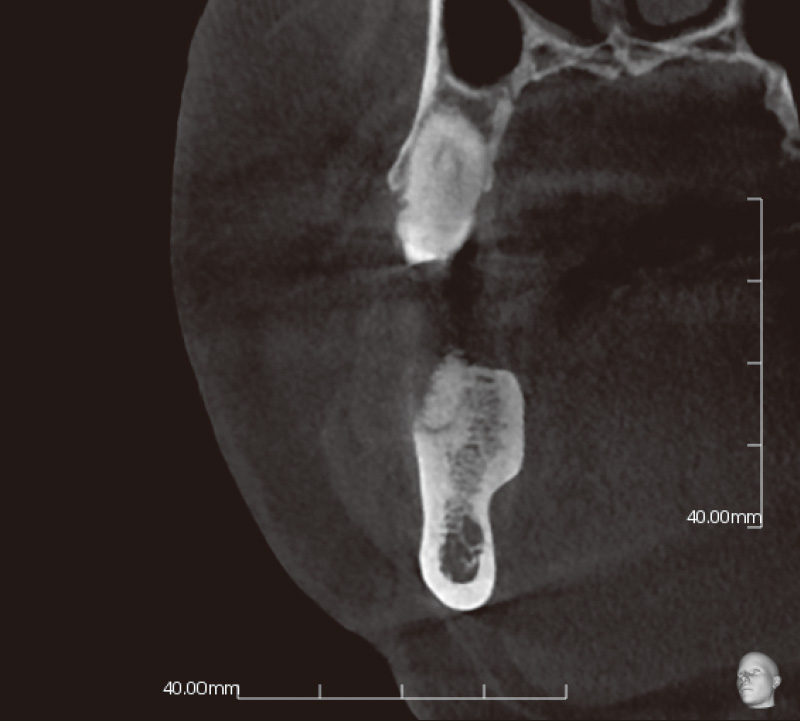 [写真] 術後6ヵ月のCBCT像