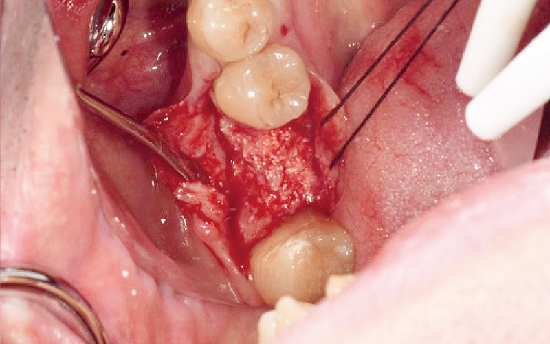 [写真] 術後6ヵ月後、インプラント体埋入直前の口腔内の状況