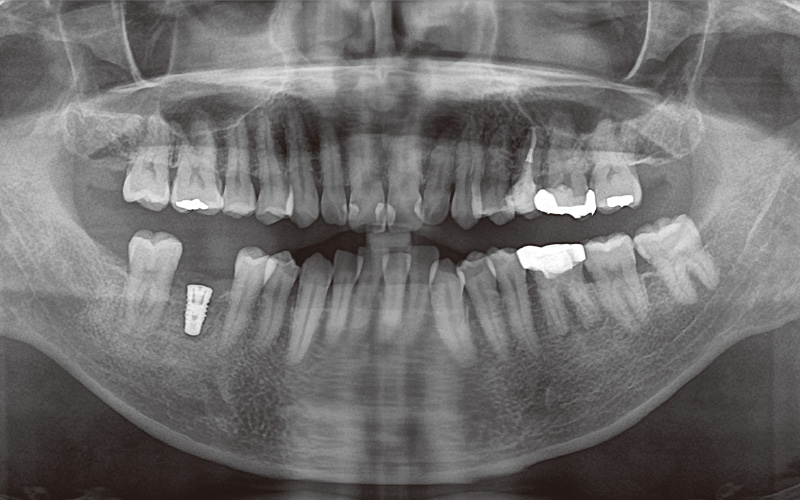 [写真] インプラント体埋入直後