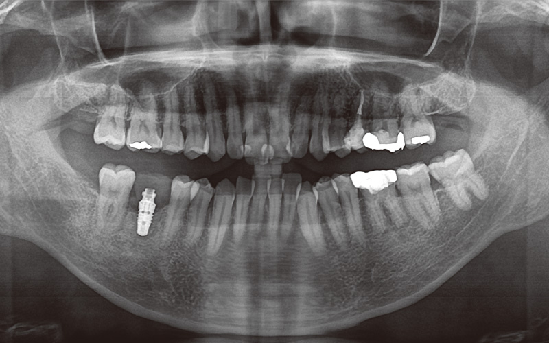 [写真] インプラントプロビジョナルクラウン装着時のパノラマX線写真