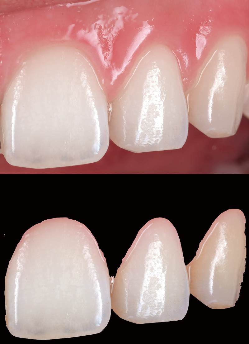 [写真] 天然歯写真の歯牙を切り取ると歯頸部にピンク色が確認できる