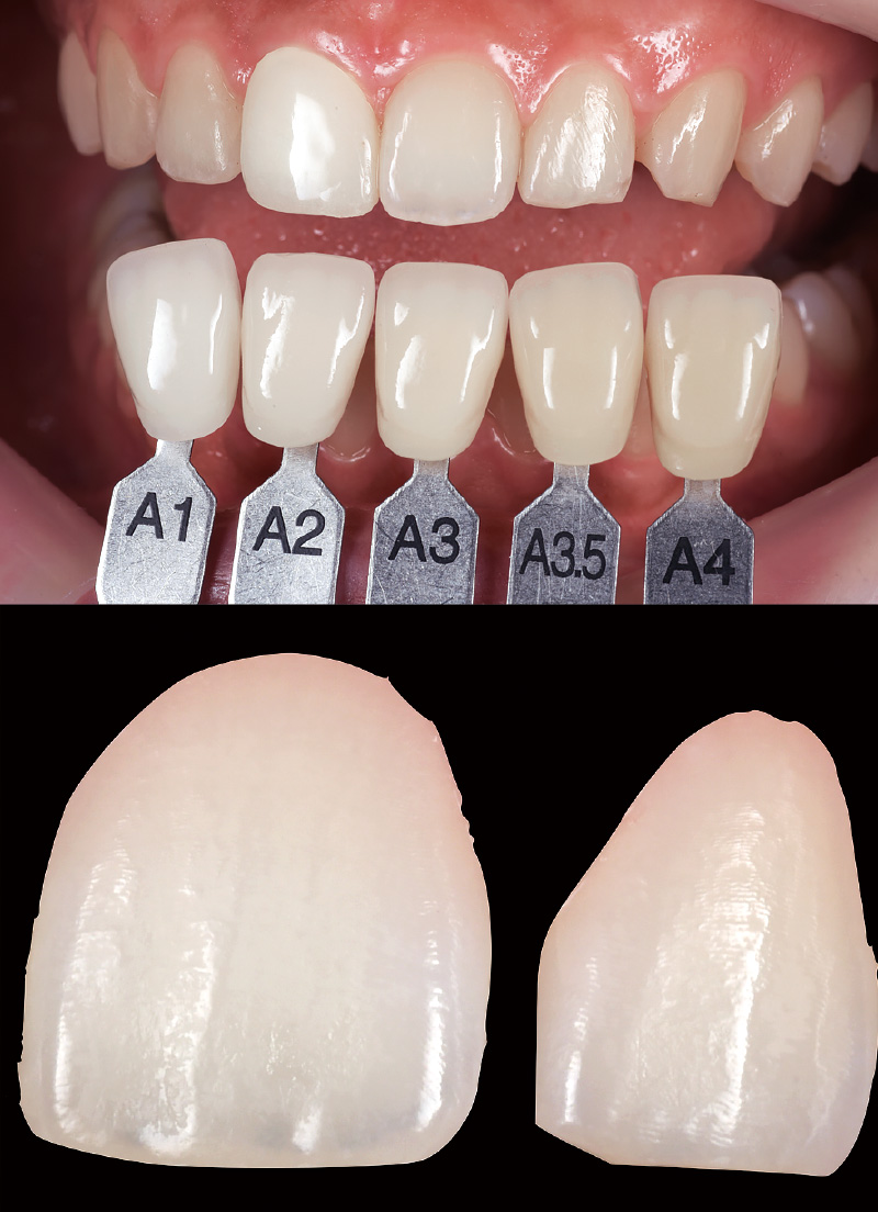 [写真] 目標歯の歯牙を切り取るとピンク色が確認できる