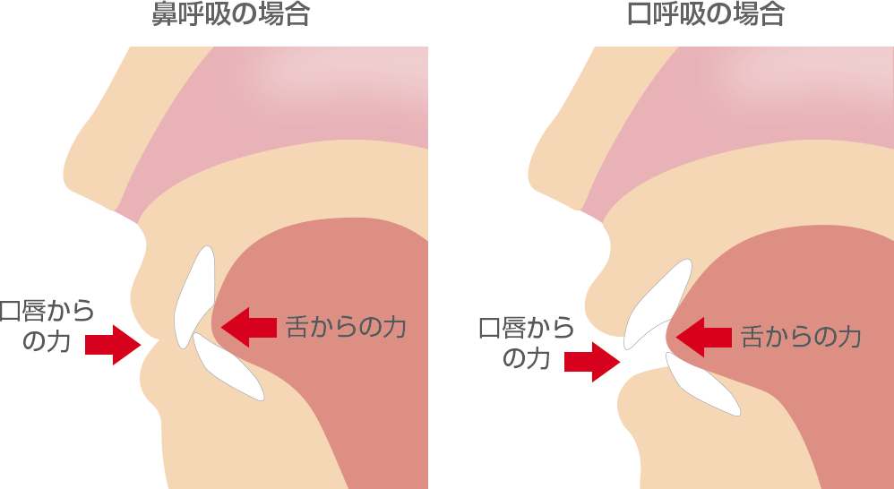 [図] 前歯の位置は舌の圧力と口唇の圧力のバランスで決まる