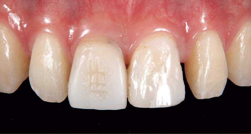 [写真] 左右中切歯に不良修復物、左右犬歯近心部と左側側切歯近心部に空隙が認められる
