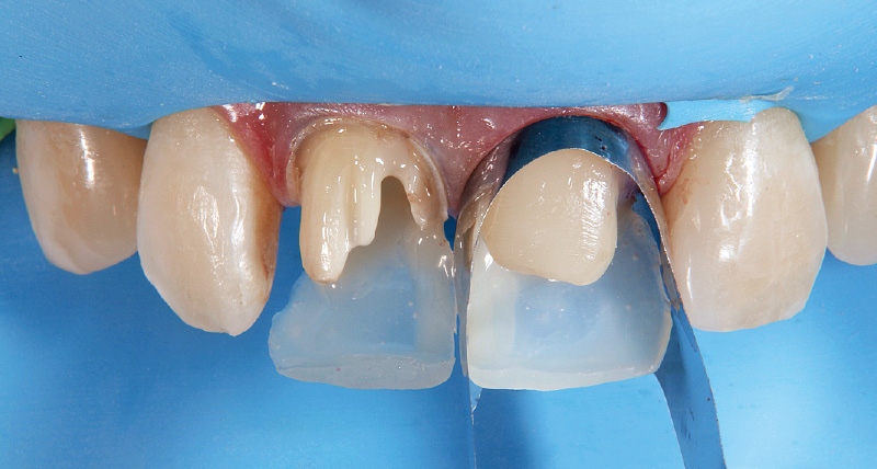 [写真] 直接法にて歯冠部を修復している途中。