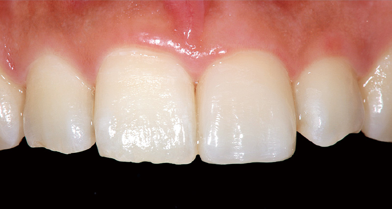 [写真] 反対同名歯の形態を参考にしながら、「クリア フィル マジェスティ ES フロー Universal」で最終形態付近まで築盛