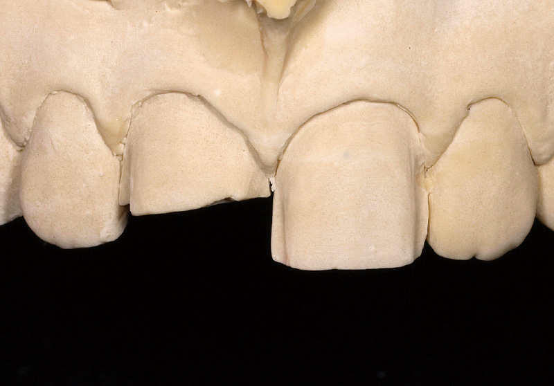 [写真] 破折した支台歯