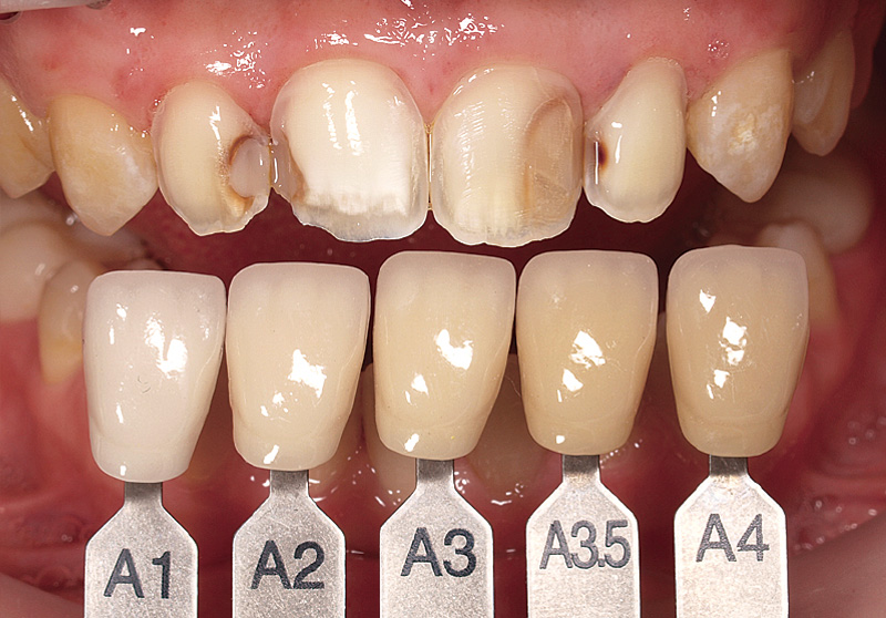 [写真] 支台歯の色調確認