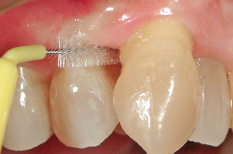 [写真] 歯間ブラシによる清掃を行う
