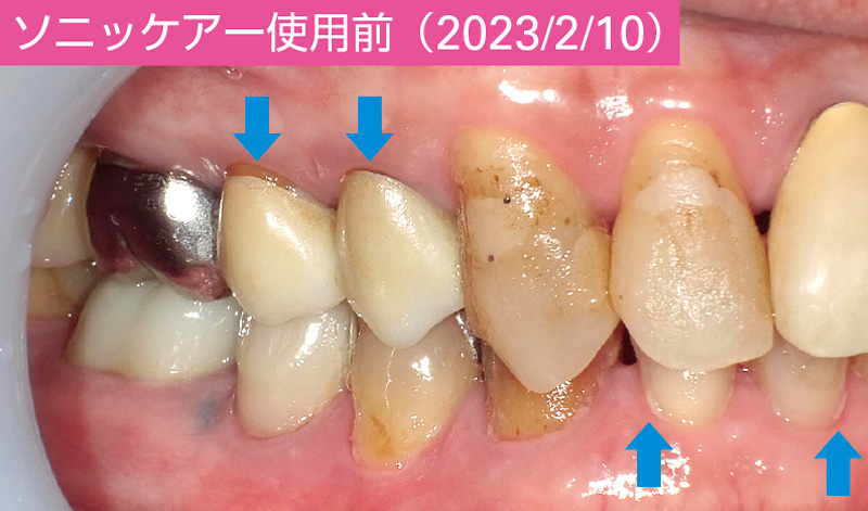 [写真] ソニッケアー使用前（2023/2/10）