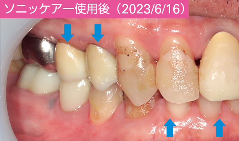 [写真] ソニッケアー使用後（2023/6/16）